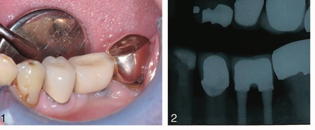 Peer Reviewed Studies of Mini Dental Implants - Tuckerton Dental