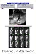 Impacted 3rd Molar scans
