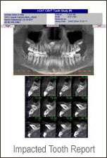 Impacted Tooth Report scans