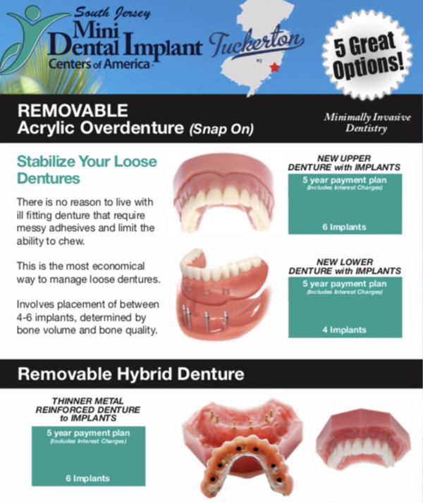 Removable acrylic denture