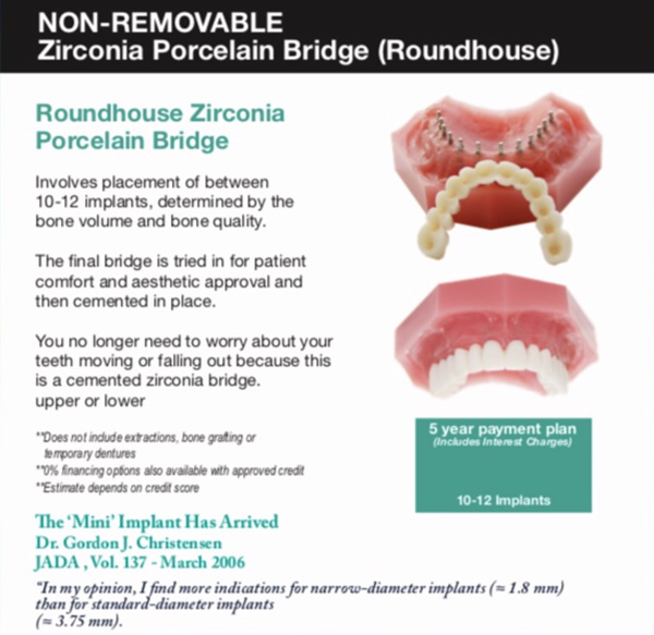 Non-removable zirconia porcelain bridge