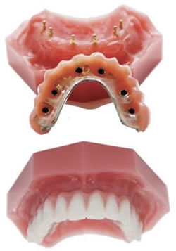Hybrid dental implant