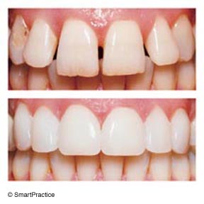 before and after porcelain veneers