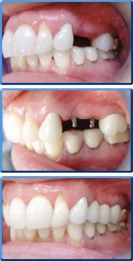 The steps of a mini dental implant process