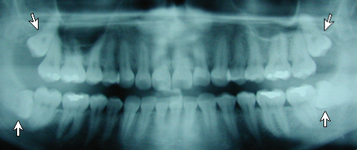 impacted teeth on an x-ray
