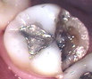 large tooth decay
