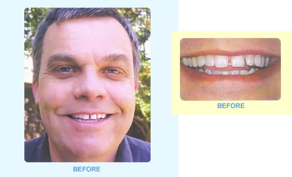 before and after dental treatment