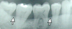How periodontitis looks on an x-ray