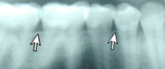 Healthy gums and bone on an x-ray