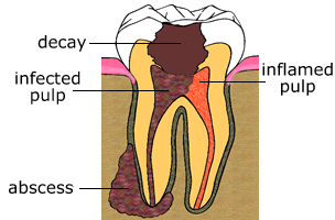 how root canal therapy works