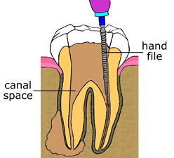how root canal therapy works