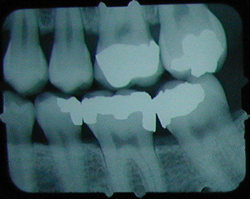 X-ray of a tooth without a cavity