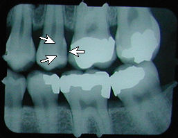 X-rays of a tooth