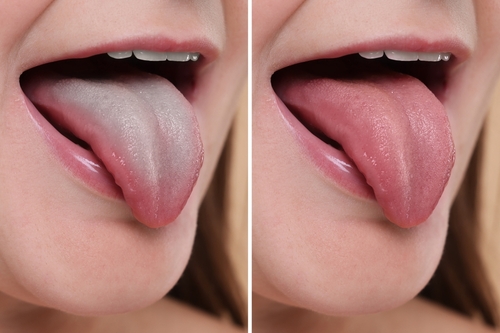 before and after tongue scraping