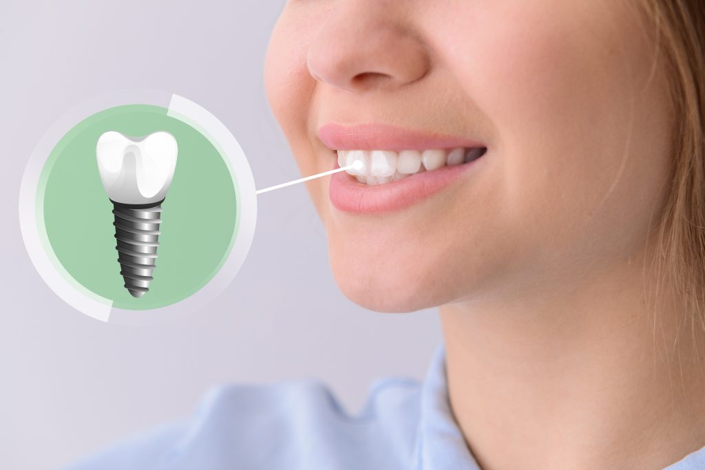 dental implant