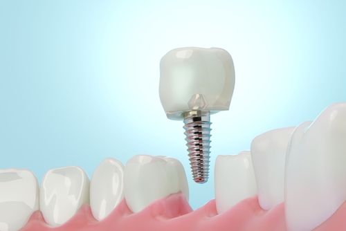 dental implant