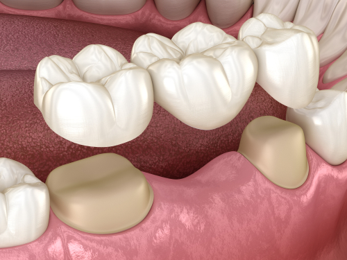 a dental bridge