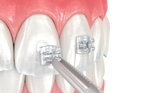 What Causes Braces' Brackets to Fall Off?