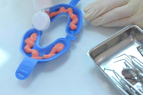 Dentist,Is,Putting,Fluoride,Gel,In,Mouth,Guard,In,Stomatology